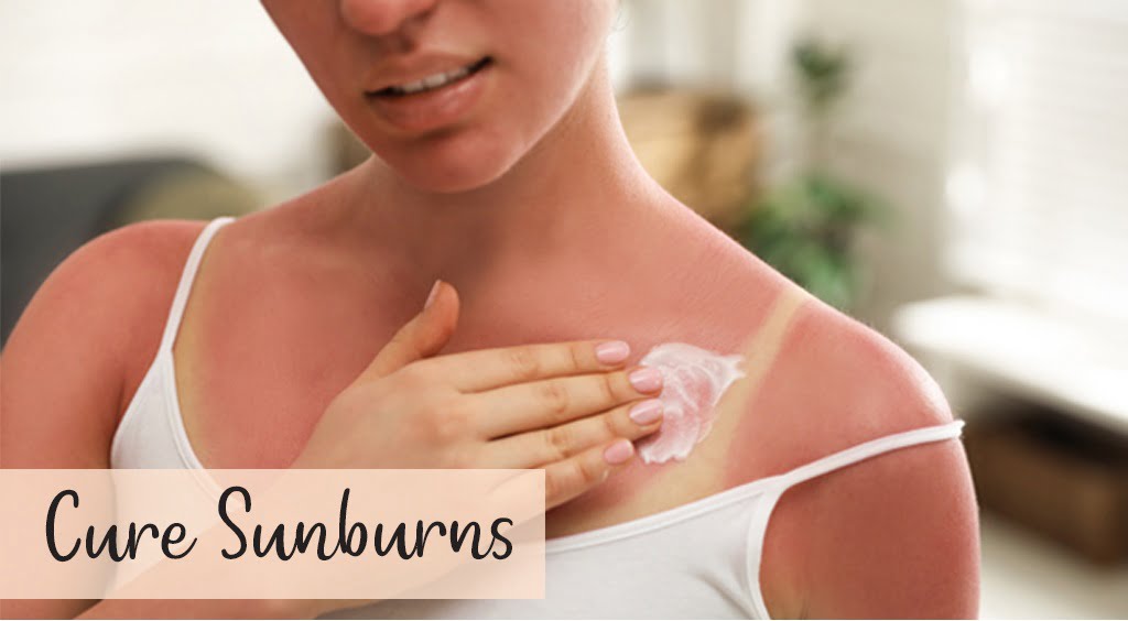 Sunburn - 5 Home Remedies To Get Rid Of It! - By Dr. Deepti Gupta